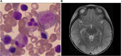 Case Report: Clinical and Genetic Characteristics of Pearson Syndrome in a Chinese Boy and 139 Patients